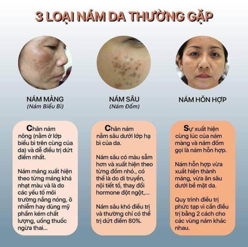 3 loại nám da thường gặp