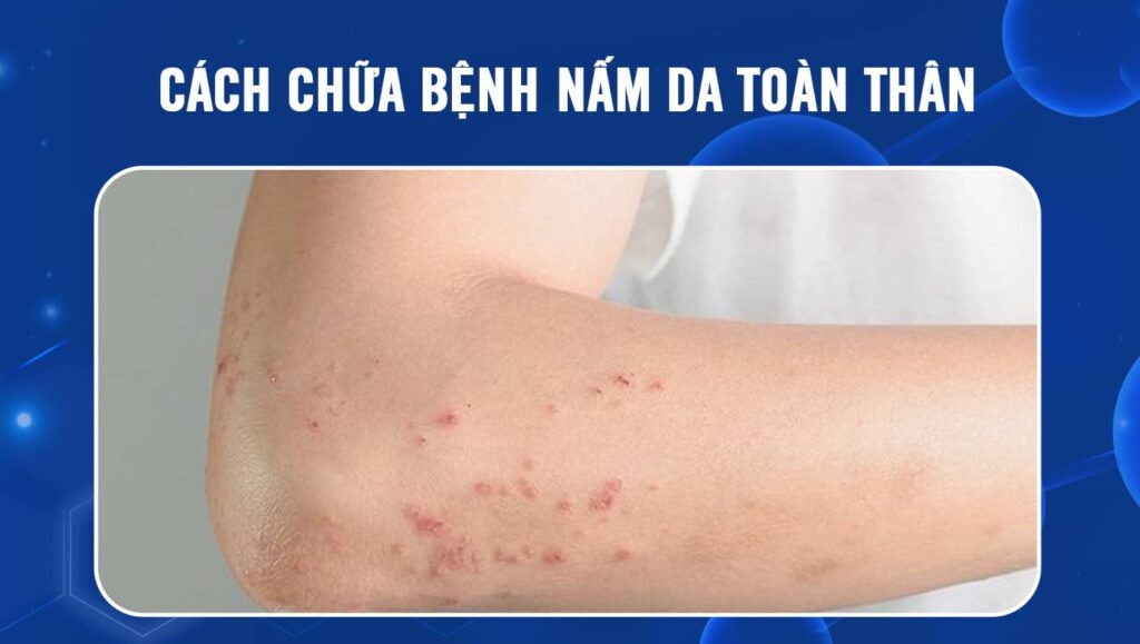 điều trị nấm da