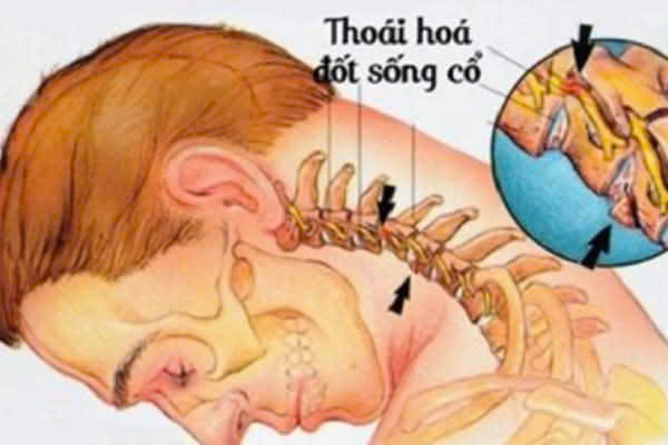 thoái hóa đốt sống cổ